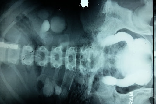 Robotic augmentation ileocystoplasty 